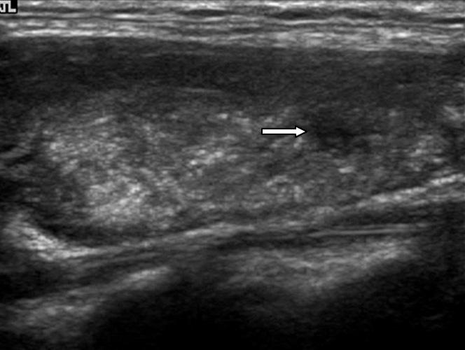 A ill defined small hypoechoic and solid nodule is noted (white arrow).