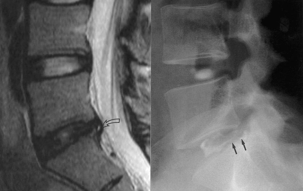 Grade 2 14 9 3 5 3 9 0.040 Fig. 1. A 53-year-old woman showing correlation of decreased signal intensity of disc on T2-weighted image and disc degeneration and radial tear on CT discography. A. Sagittal T2-weighted image demonstrates decreased signal intensity of L4-5 disc (arrow).