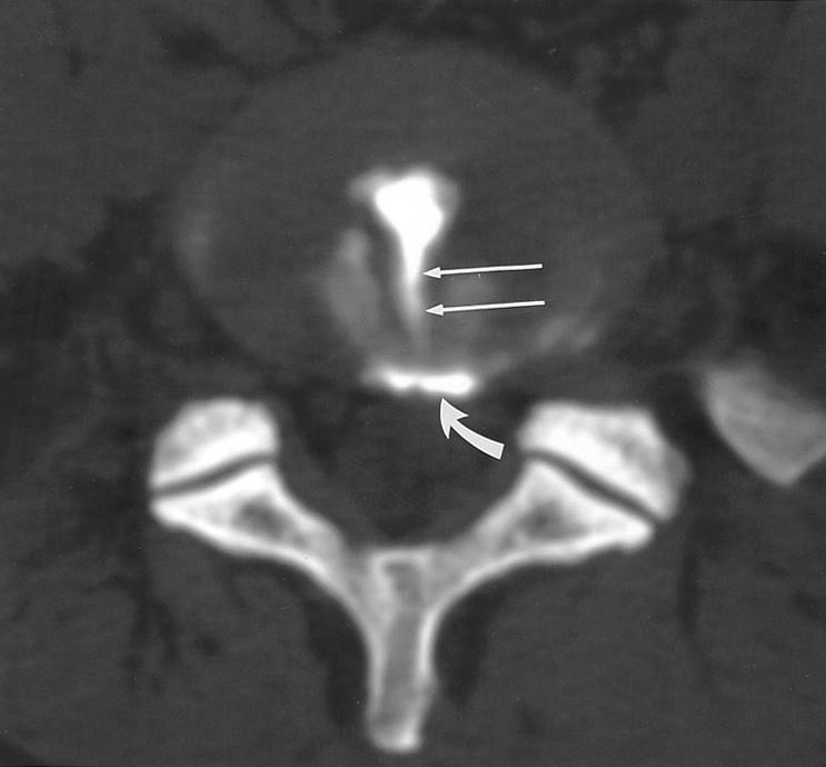 CT discogram at L4-5 level shows multiple irregular annular tears (short arrows) and a radial tear (long arrow) of the disc. Discography provocated concordant pain at this level. B A B C Fig. 2.