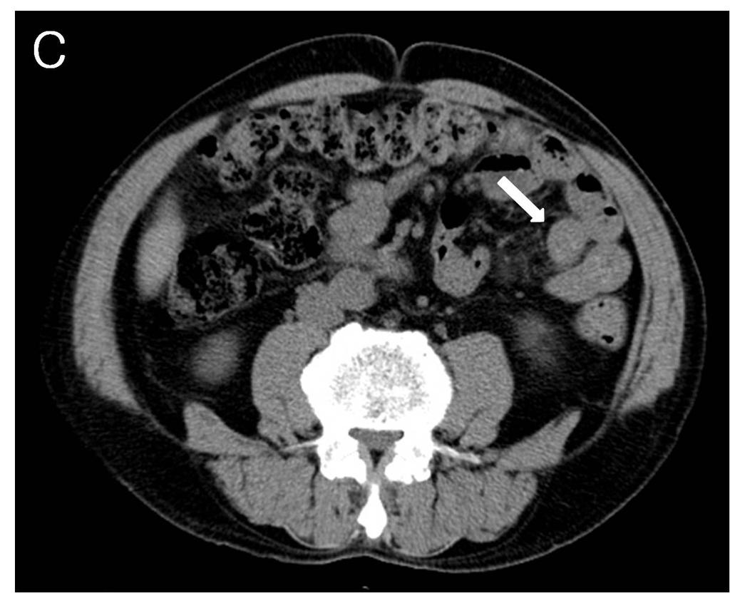 (A) Noncontrast CT scan showed homogeneous, hyperdense (55 HU), circumferential thickening of the jejunal wall (arrow), and associated perienteric infiltration with mesenteric haziness (arrowhead).