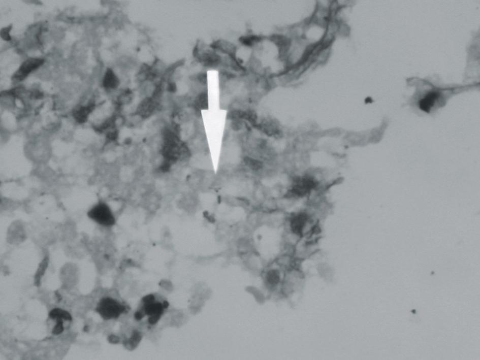 102 대한내분비외과학회지 제 5 권 제 2 호 2005 ꠏꠏꠏꠏꠏꠏꠏꠏꠏꠏꠏꠏꠏꠏꠏꠏꠏꠏꠏꠏꠏꠏꠏꠏꠏꠏꠏꠏꠏꠏꠏꠏꠏꠏꠏꠏꠏꠏꠏꠏꠏꠏꠏꠏꠏꠏꠏꠏꠏꠏꠏꠏꠏꠏꠏꠏꠏꠏꠏꠏꠏꠏꠏꠏꠏꠏꠏꠏꠏꠏꠏꠏꠏꠏꠏꠏꠏꠏꠏꠏꠏꠏꠏꠏꠏꠏꠏꠏꠏꠏꠏꠏꠏꠏꠏꠏꠏꠏꠏꠏꠏꠏꠏꠏꠏꠏꠏꠏꠏꠏꠏꠏꠏꠏꠏ A C B Fig. 3. (A) Microscopic examination.