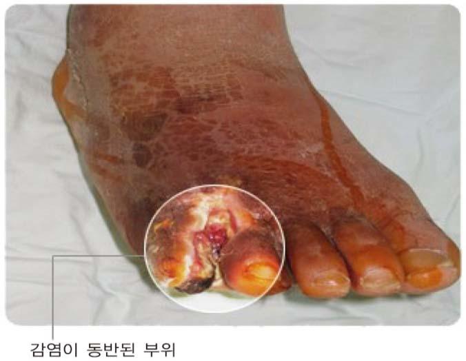 2. 당뇨병의만성합병증 (1) 심혈관계합병증 당뇨병은고혈압, 뇌혈관질환, 심혈관질환과동맥경화촉진시키는위험인자 제2형당뇨병으로 LDL-콜레스테롤, VLDL-콜레스테롤중성지방상승하고 HDL-콜레스테롤저하