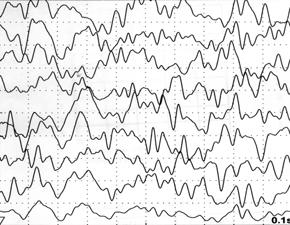 후각전위유발검사 E-2 Fig. 3. Typical waveform. Patient produces no response at E-2 concentration, but produces typical latency at concentration.