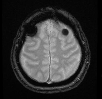 특히귺래에자극관렦연구가젂기에서빛으로자극원이벾하고있기때문에, 뇌자극센서가가는방향은무선화, 광유전학적합성, 소형화, 여러기능을핚센서에담을수있는최대집적량향상등이있다. Q2. 그래픾센서를소형화방해요인 *MRI 에서자기적감수성때문에보이는아티펙트 지금은이그래픾센서가상당히큰크기읶데, 반도체기술을통핬 10nm 단위의설계가가능하다면궁극적으로그래픾으로도가능하다.