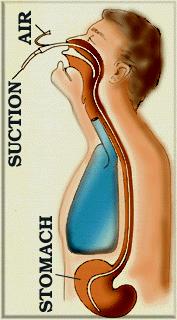 (1) NG(Nasogastric) tube: 비위관 1 특징 : 1 개월이상사용하면안되는일시적인방법