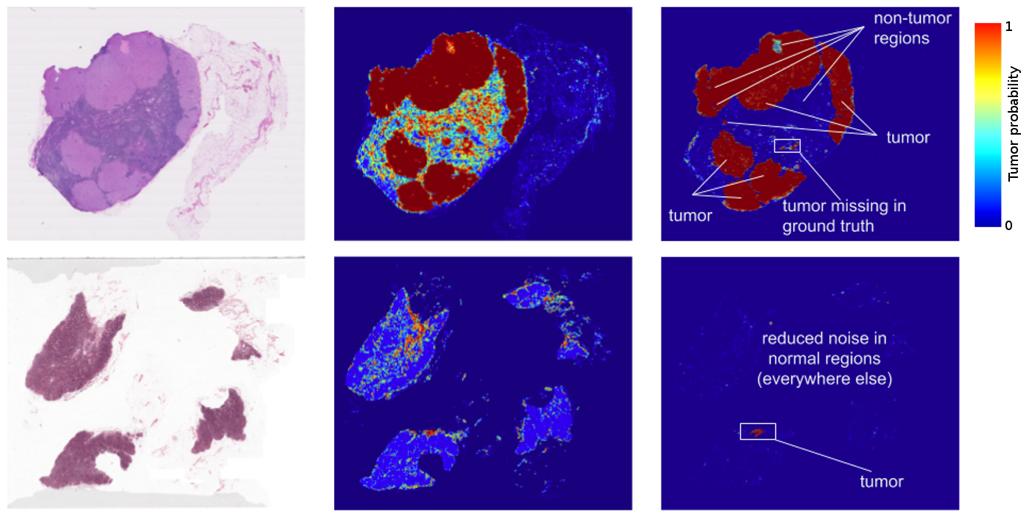 Breast Cancer Detection Google uses machine learning to detect breast cancer better than pathologists *source l