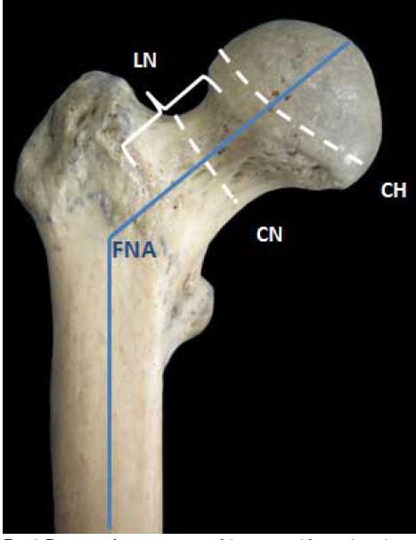 Femoral Neck Angle http://www.scielo.