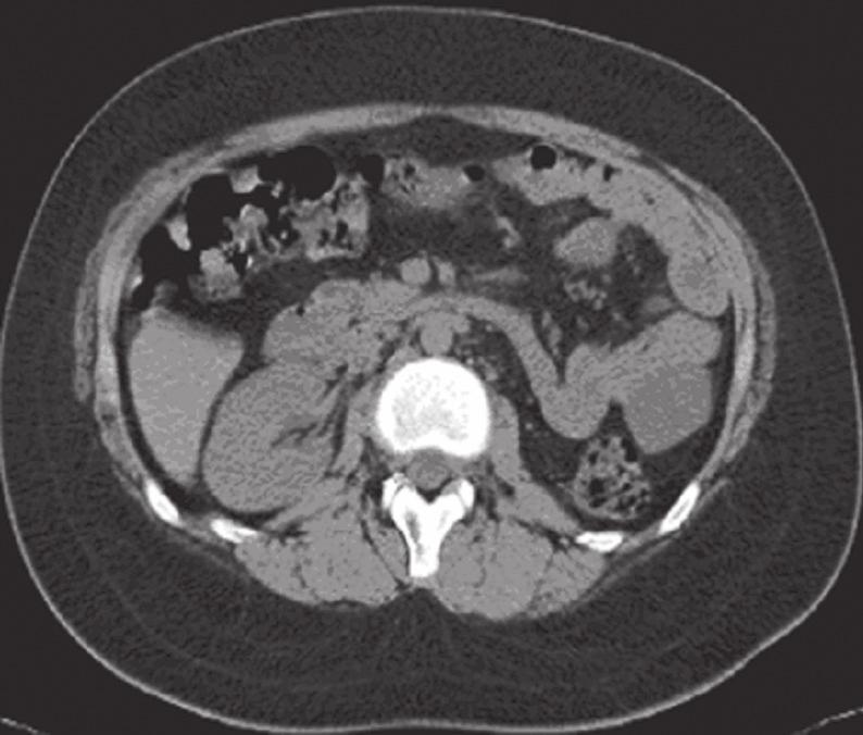 A Case of Kallmann s Syndrome with Frontal Lobe Atrophy and Mental Retardation 143 Fig. 2.