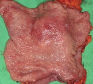 invasion 가능성있음 Frozen biopsy: moderately differentiated adenocarcinoma Distal pancreatectomy