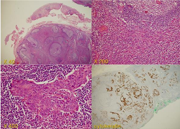 Adenocarcinoma, poorly differentiated, solid type (por1) 1) prominent lymphoid stroma