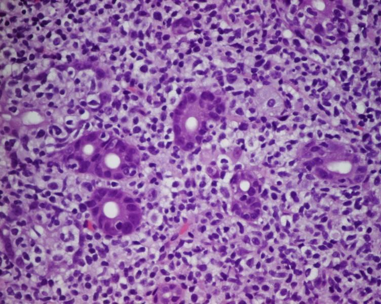 Lymphoepithelial