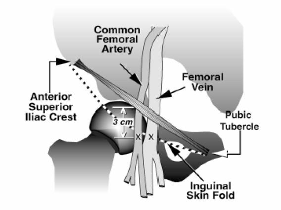분과 233 6. 대퇴동맥의천자와삽관 1) 해부학적구조 : 대퇴동맥은외장골동맥으로부터기시하며 symphysis pubis 와 ASIS (anterior superior iliac spine) 을연결하는 inguinal ligament 의중앙부위에서약 3~4 cm 하방에위치한다. 대개이부위는서혜부의피부선과일치하는부위이다.
