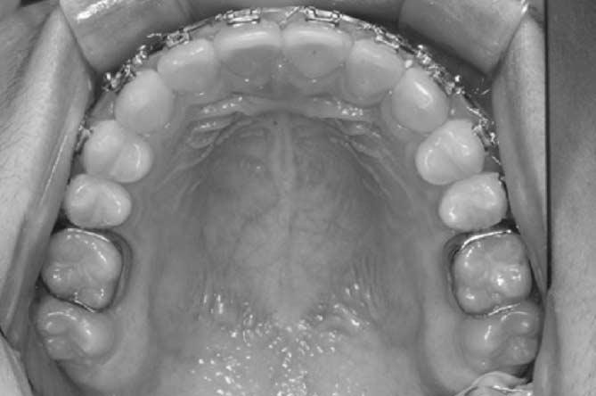 Occlusal view before treatment. Fig. 2.