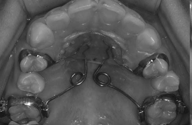 No space for eruption of 2nd premolars. Fig. 8. Occlusal view at 2 months after pendulum appliance activation. Fig. 9.