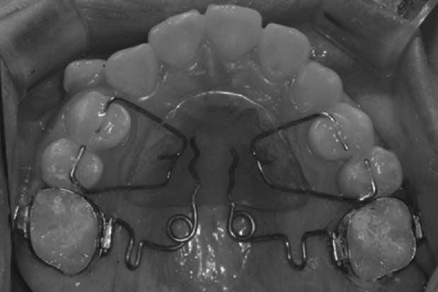 Lateral view of anterior occlusion at 7 months after pendulum removal.