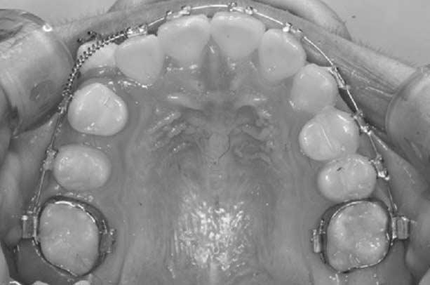 Fig. 15. Occlusal view at 4 months after pendulum appliance activation. Distalization of molar and premolar were shown. Fig. 16. Occlusal view at 1 month after fixed orthodontic treatment. Fig. 17.