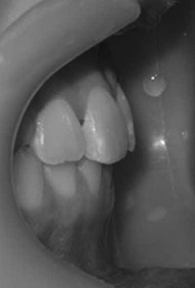 orthodontic treatment following pendex