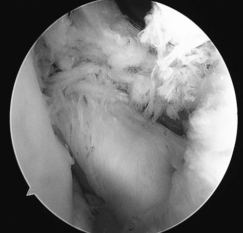 394 김영규ㆍ김동욱ㆍ노영태외 1 인 Figure 2. Repair of subscapularis using two anterior portals. (A) The completely torn and retracted subscapularis tendon (arrow).