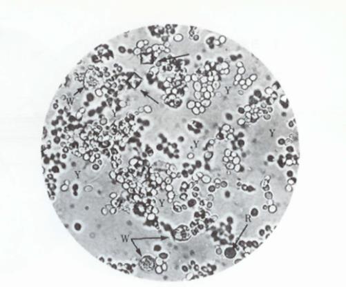 6. Hematuria 의의및원인 (5) Microscopic examination 에서 RBC 로오인 되는 crystal 진균 무색원형또는타원형으로크기가일정치않음, 알칼리성뇨에출현, 몇개가군집또는발아하여아포를내는것이특징, 10% 초산에적혈구는용해되나진균은비용해