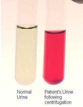 7. Hemoglobinuria 의의및원인 의의 : Intravascular hemolysis 로용혈된 free Hb 이유출되어혈색소증 (hemochromatosis) 을일으키고유리한혈색소와그유도체가신장을통해요중으로배설 1. 육안적혈뇨 : 선홍색, 암갈색, 원심후상층의색깔도같음 2. 현미경검사 : 요침사에서적혈구관찰불일치 원인 1.