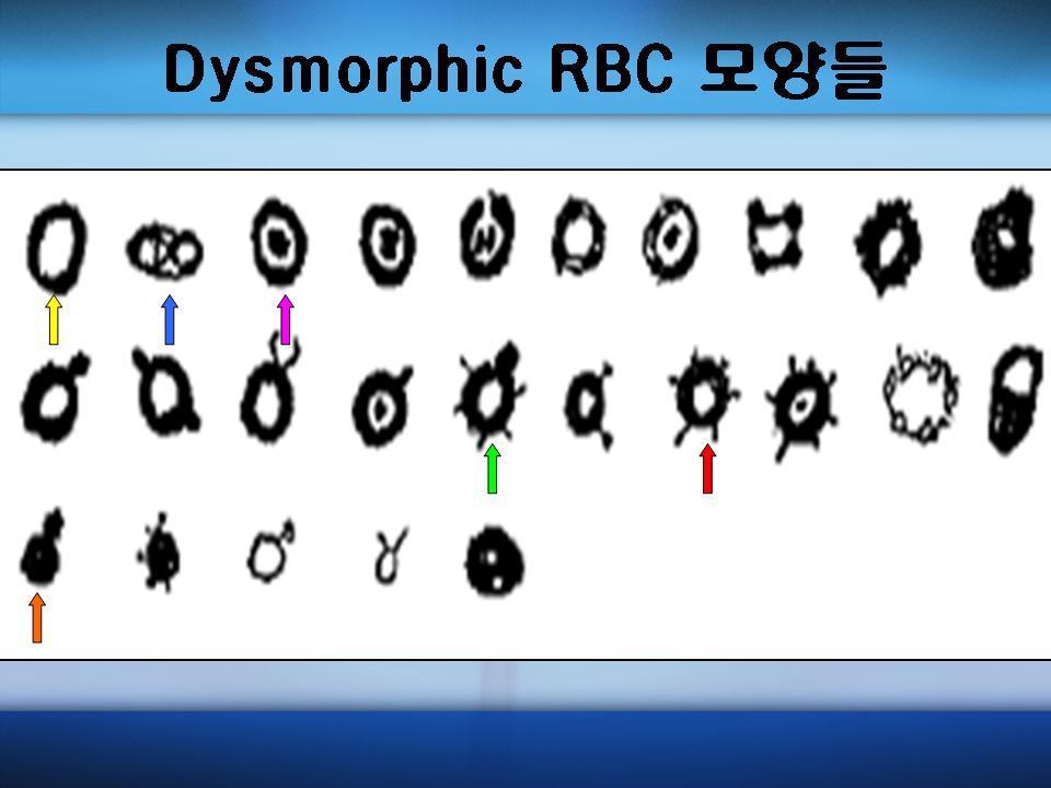 5. Dysmorphic