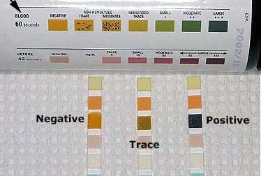 3. Urine Blood Test result The resulting color ranges from orange through green. (very high levels of blood may cause the color development to continue to blue) The normal test sensitivity is 0.015-0.