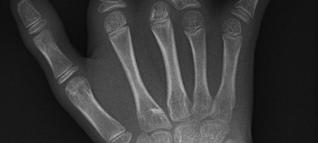 Polydactyly) 2 3-4