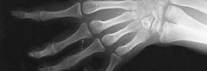 엄지는없고손가락만이 7~8개 1 매우희귀하며이중척골 (ulnar dimelia) 라고도함 2 유전성질환은아니라고추정,