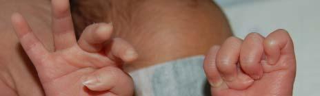 V. Undergrowth # Congenital clasped thumb ( 선천성내전굴곡무지 ) 1 2 3 4 5 6