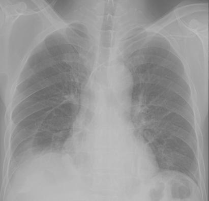 - Yong-Jin Kwon, et al. A case of pulmonary hemorrhage through pulmonary involvement of Henoch-Schönlein purpura - A B C Figure 2.