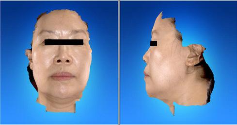 YG Park et al. 181 Figure 1. Anterior view and lateral view of face scanned by 3D facial scanner (RFS-S100) (September.-11-2014) 조절한다. 容貌詞氣 : 피부가희고인상이순하다. 이목구비가뚜렷한편으로눈빛이날카롭지않고눈꼬리가쳐져있다.