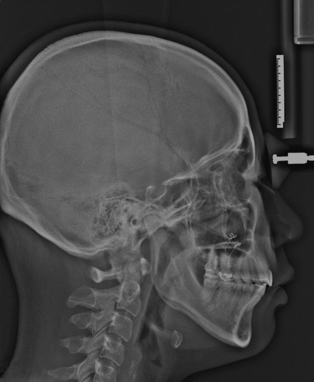 골격성개방교합을보이는 II 급장안모환자에서피질골절제술 (Corticotomy)