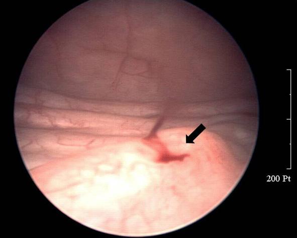 - The Korean Journal of Medicine: Vol. 76, Suppl. 1, 2009 - Figure 1. At cystoscopy, bloody urine was seen flowing from the left ureteral orifice (arrow). Figure 2.