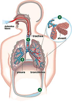 석면질병 폐암 (lung cancer) 석면폐 (asbestosis) 흉막 - 중피종암 (mesothelioma) /