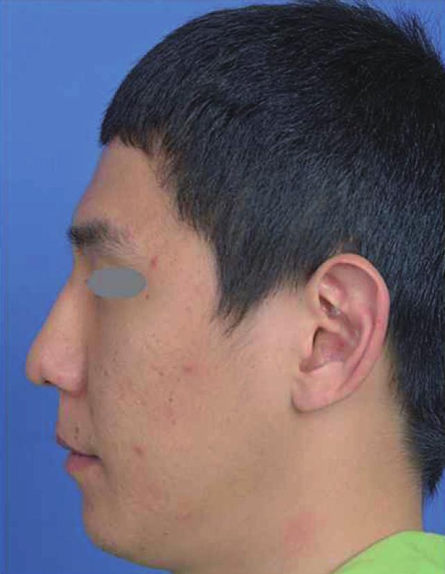 and postoperative frontal view nasal axis deviation was measured by the angle between Line 1 and Line 2.