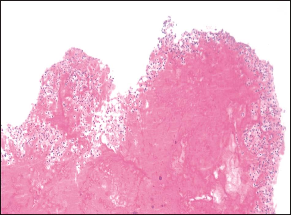 황세진외 : 다발성말초동맥색전증을동반한 Pasteurella Multocida 에의한인공판막심내막염 1 예 (peroneal artery) 의폐색이관찰되었고, 측부순환에의해슬와동맥아래쪽혈관들이재구성되어있는것을확인하였다 (Fig. 2). 오른쪽위팔동맥에대해서는부분마취하에색전제거술을시행하였다 (Fig. 3).
