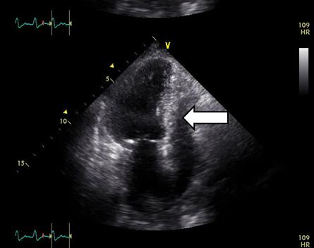 anteroseptal wall (arrow) that was not consistent with an ischemic coronary artery territory (A, B apical 4-chamber view diastolic