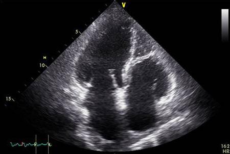 - 대한내과학회지 : 제 85 권제 6 호통권제 640 호 2013 - A B C D Figure 5. Echocardiography performed on day 4 showed severe left ventricular dysfunction.