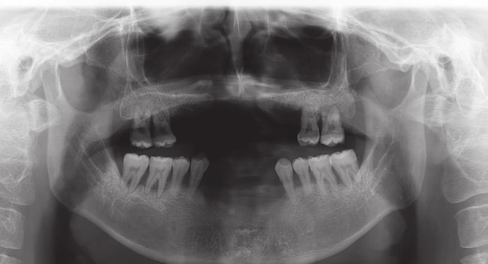 Treatment of the cleft lip and palate patient with few remaining posterior teeth using hybrid telescopic crown denture 접적으로 연결하는 방법으로 이중관 의치를 이용하면 상 #16, 17, 26의 경우는 4-6 mm의 치주낭 깊이와 함께 악의 안정에 더욱 도움을