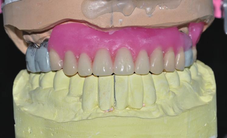 Wax denture try-in. C Fig. 9.