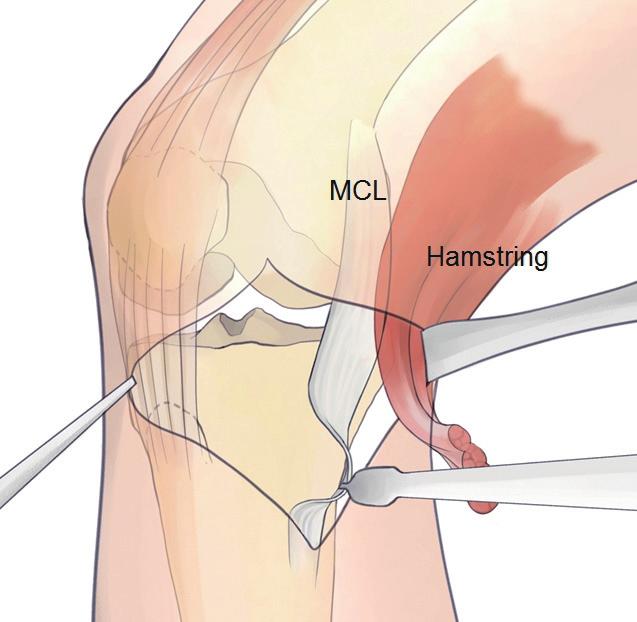 Hamstrings과 MCL 사이로 long tongue retractor를삽입하여 posterior의 neurovascular structure를보호하면서 osteotomy 부위를노출시켜줍니다.
