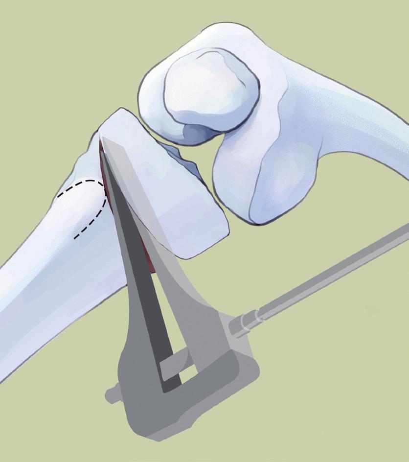 Osteotomy 3. Opening Osteotomy - 3 Chisel Technique 첫번째 Chisel을 Lateral의끝부분에서 5-10mm 위치까지삽입시킵니다.