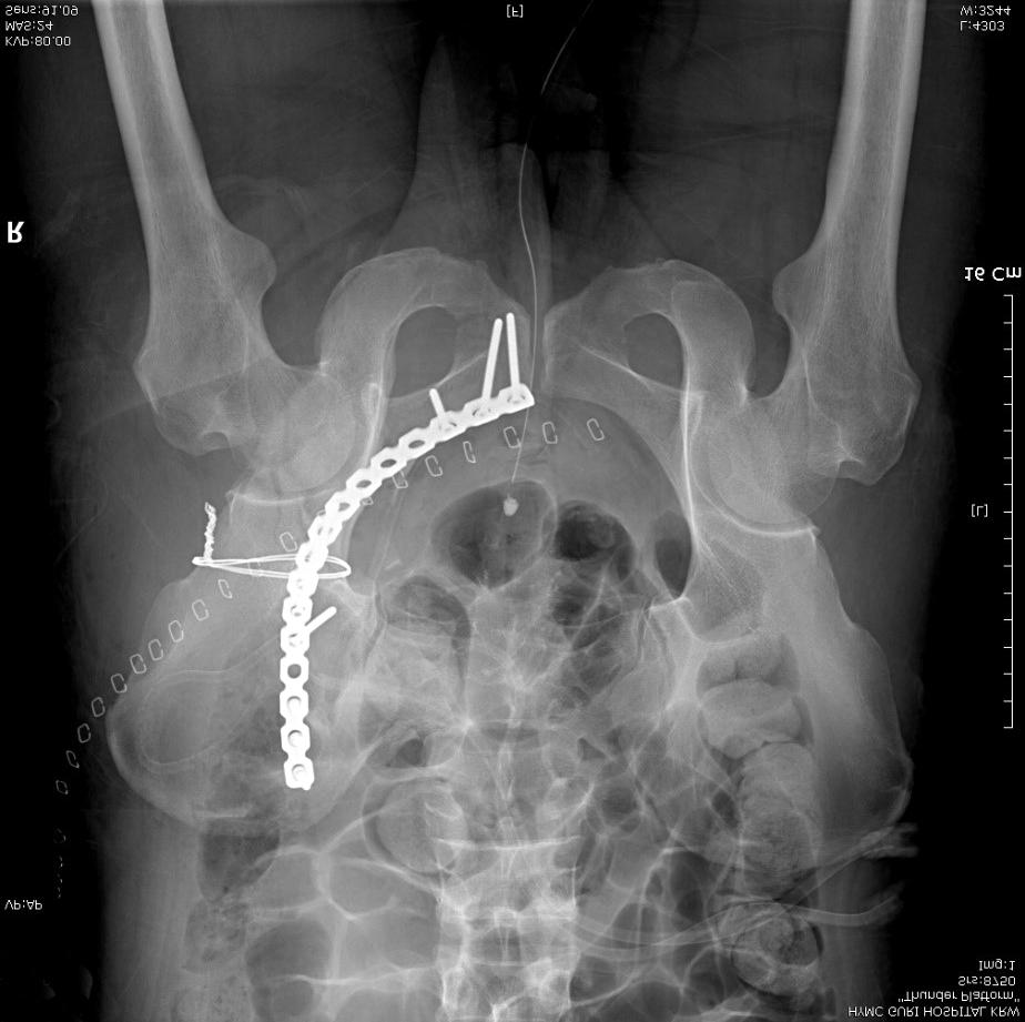 489 Cerclage Clamping for Reduction of Anterior and Posterior Column Fracture A B Figure 3. (A) Immediate postoperative radiograph shows anatomical reduction with cerclage wiring and plate fixation.