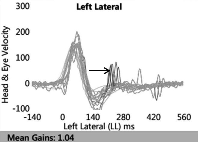 No anticompensatory saccadic eye movements (arrowhead) in cumulated recordings from repeated left SHIMP comparing with anticompensatory saccades (dotted arrow: VOR gain 1, amplitude -127 / s, latency