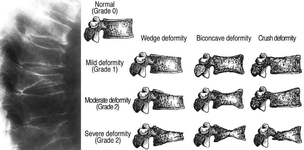 5) 말단골정량적전산화단층촬영 (PQCT; Peripheral Quantitative Computed Tomography) 골밀도측정만을위해개발된작은 CT로서요골과경골등의말단골골밀도를측정한다. Fig. 2. Microarchitecture of bone. (A) 20 years old versus (B) 80 years old. 3.