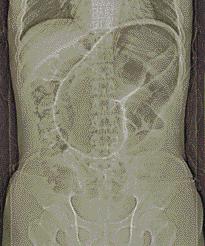 Simple abdomen shows -shaped