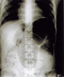 rectal gas[(a)supine view