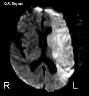 Neuroimaging Cannot be recommended alone as prognostic factor yet MRI, CT Timing: