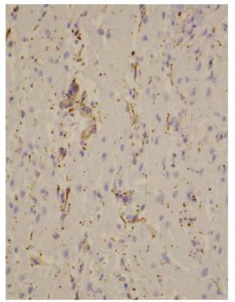 A less intense positive reaction for CD56 at bundle branches