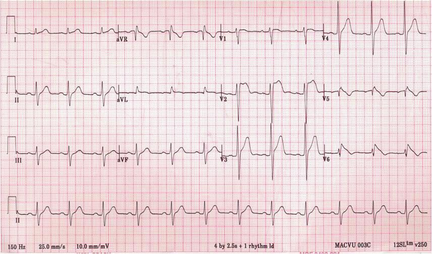 electrocardiaram(ecg) showed normal (A), and after 5 minutes,